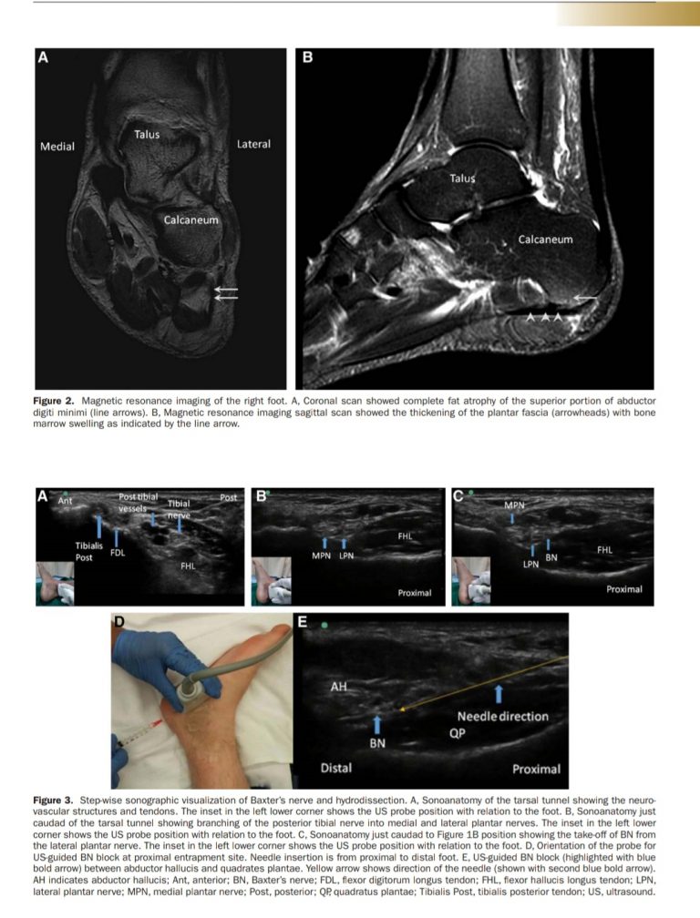 Anesthesia & Analgesia Practice Ultrasoundguided Hydro Dissection of